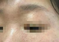 第一篇笔记献给激素依赖性皮炎真实记录
