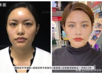 自体脂肪丰苹果肌（丰苹果肌要几支玻尿酸）