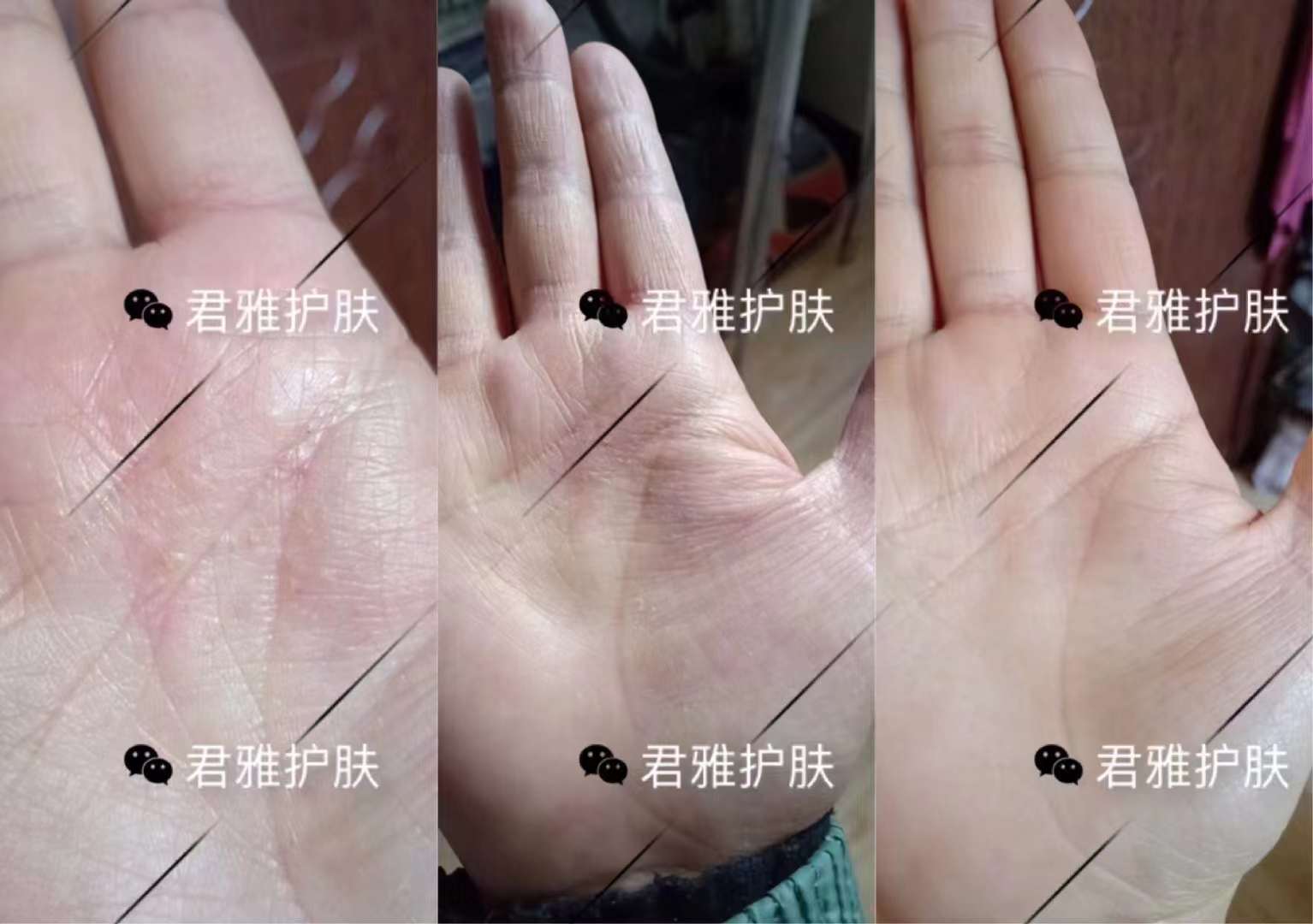 朵嘉浓的护肤品真的能修复好皮肤湿疹怎么办